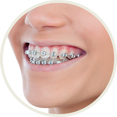 Smile with Braces